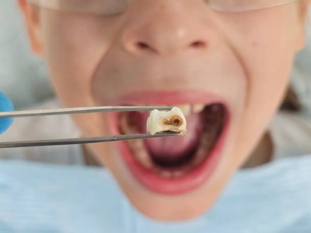 Best Emergency Treatment for Dental Infections or Abscesses in Westminster, MD